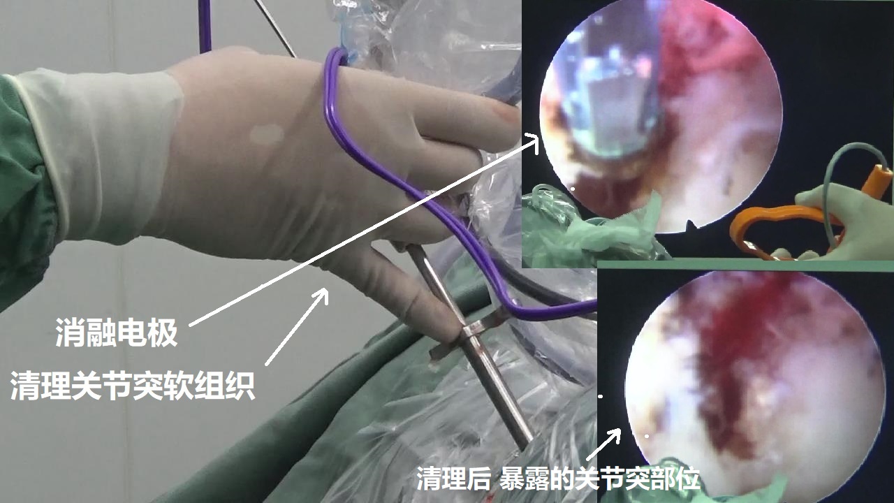 10-消融电极-清理关节突软组织.jpg