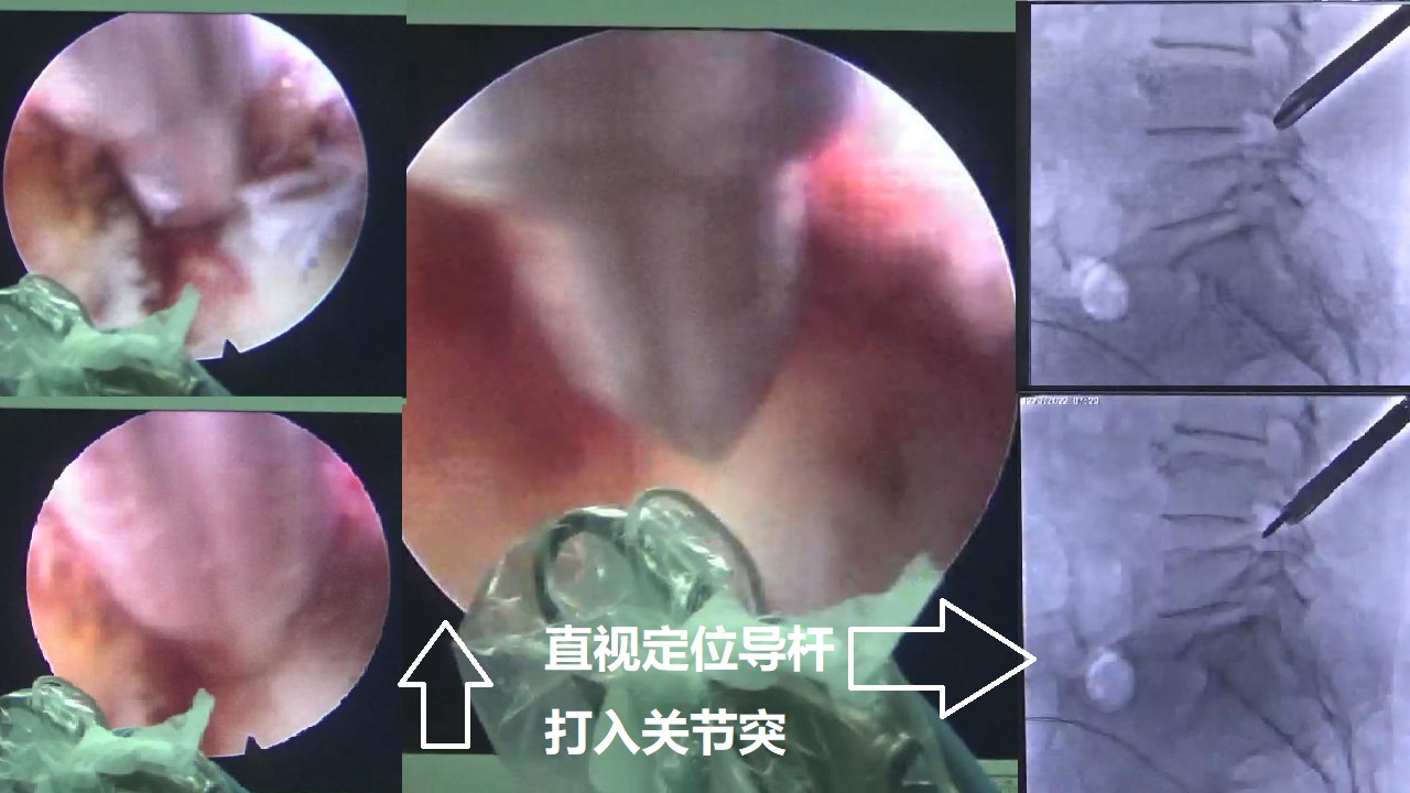 12-直视定位导杆-打入关节突.jpg