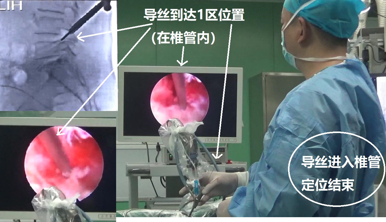 13-导丝到达椎管-定位结束.jpg