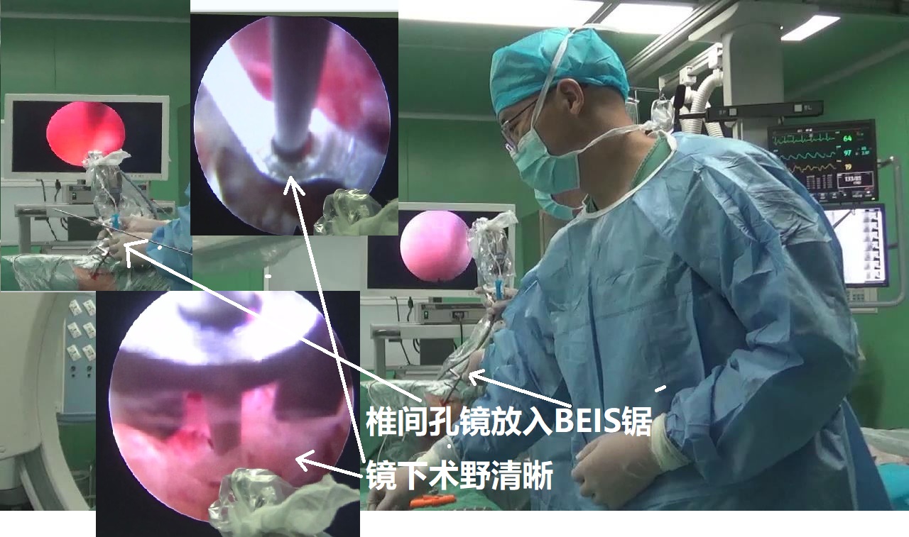 16-椎间孔镜-进入BEIS锯.jpg